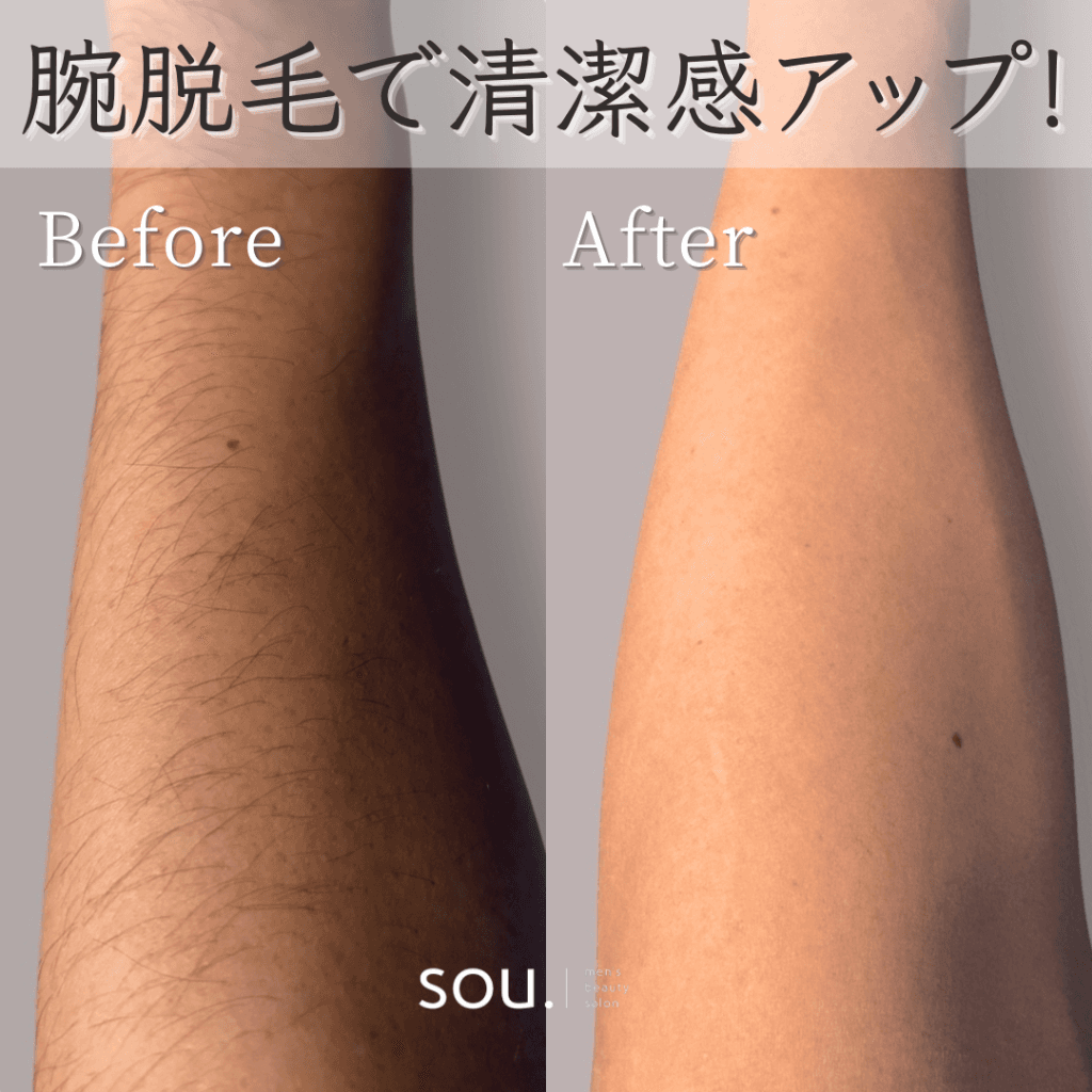 腕脱毛で清潔感アップ（ビフォーアフター）