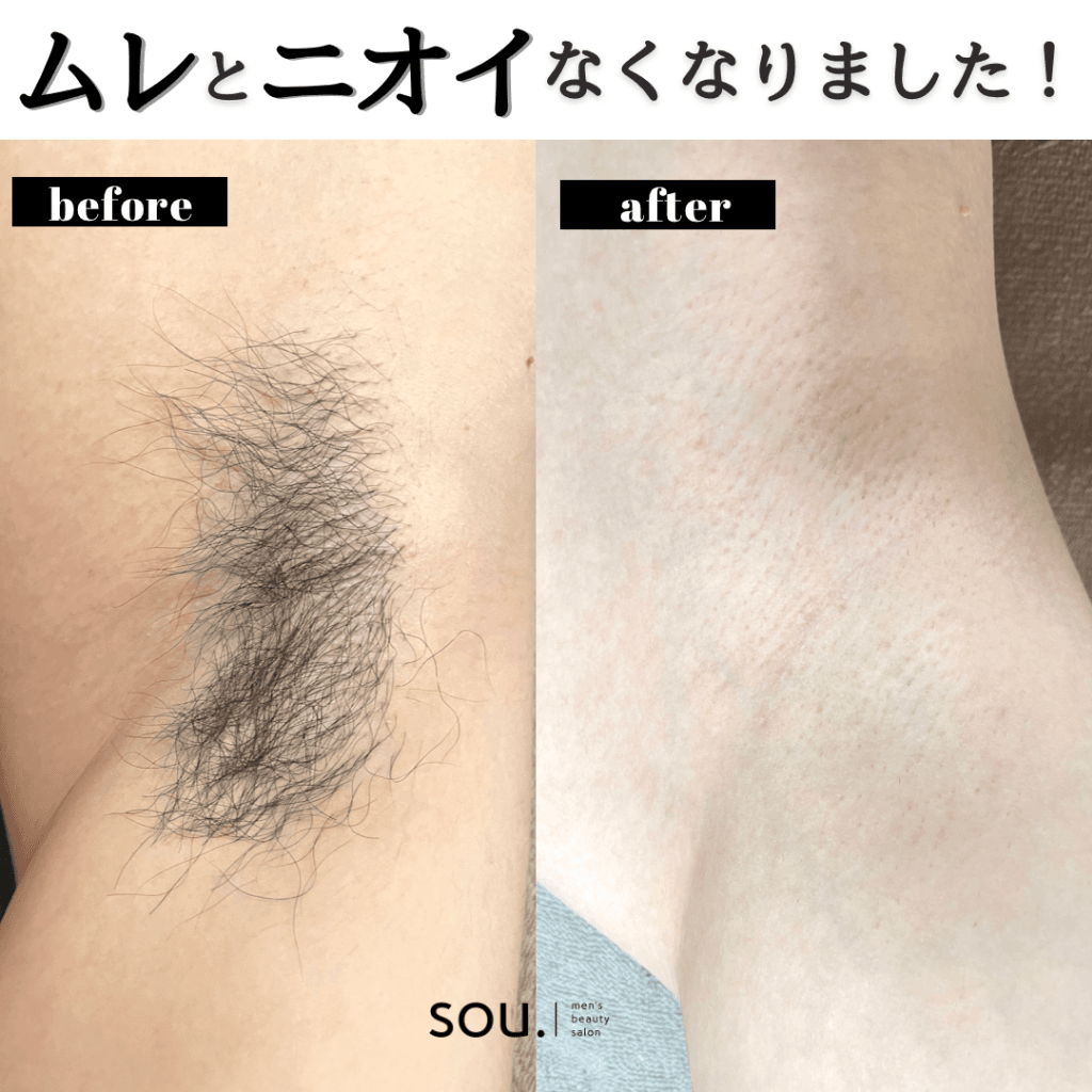 脇の脱毛 施術例（ビフォーアフター）