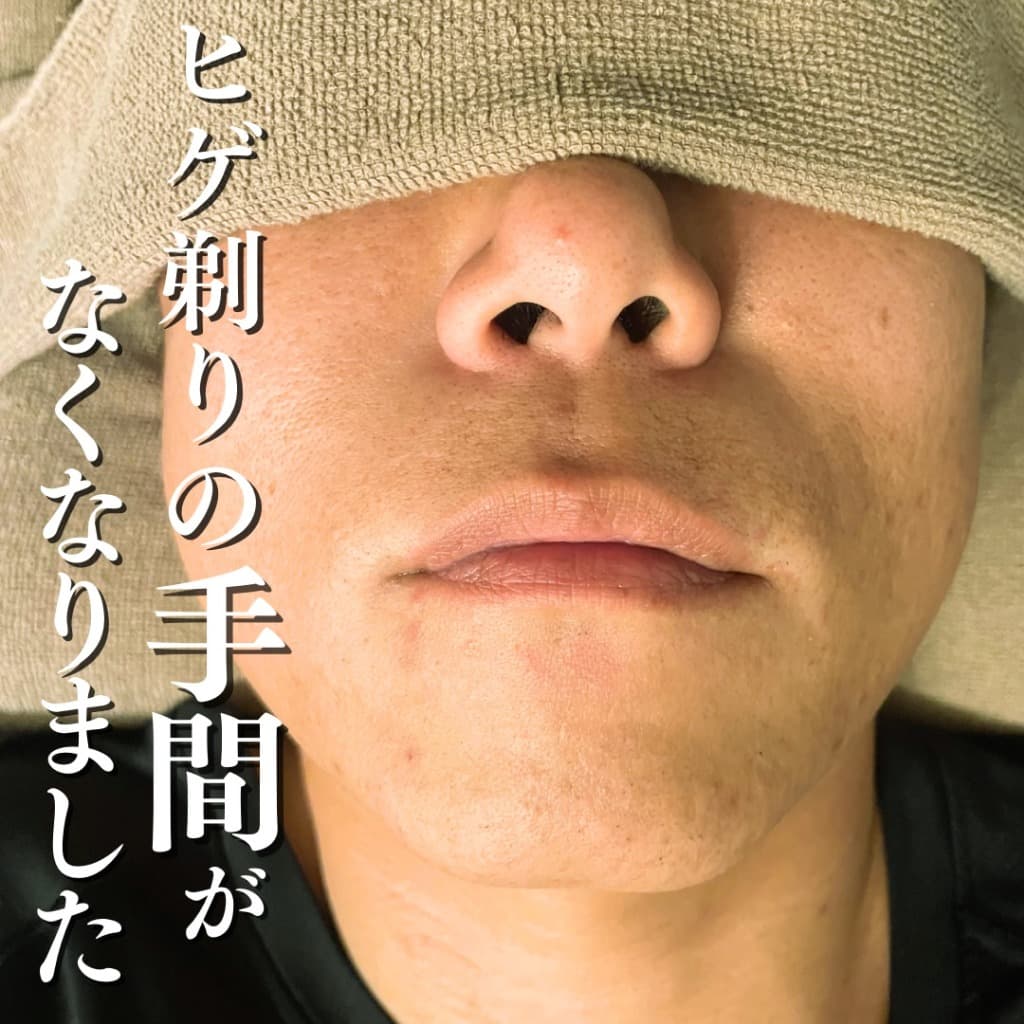 ヒゲ脱毛 施術後のイメージ（お客様の声）