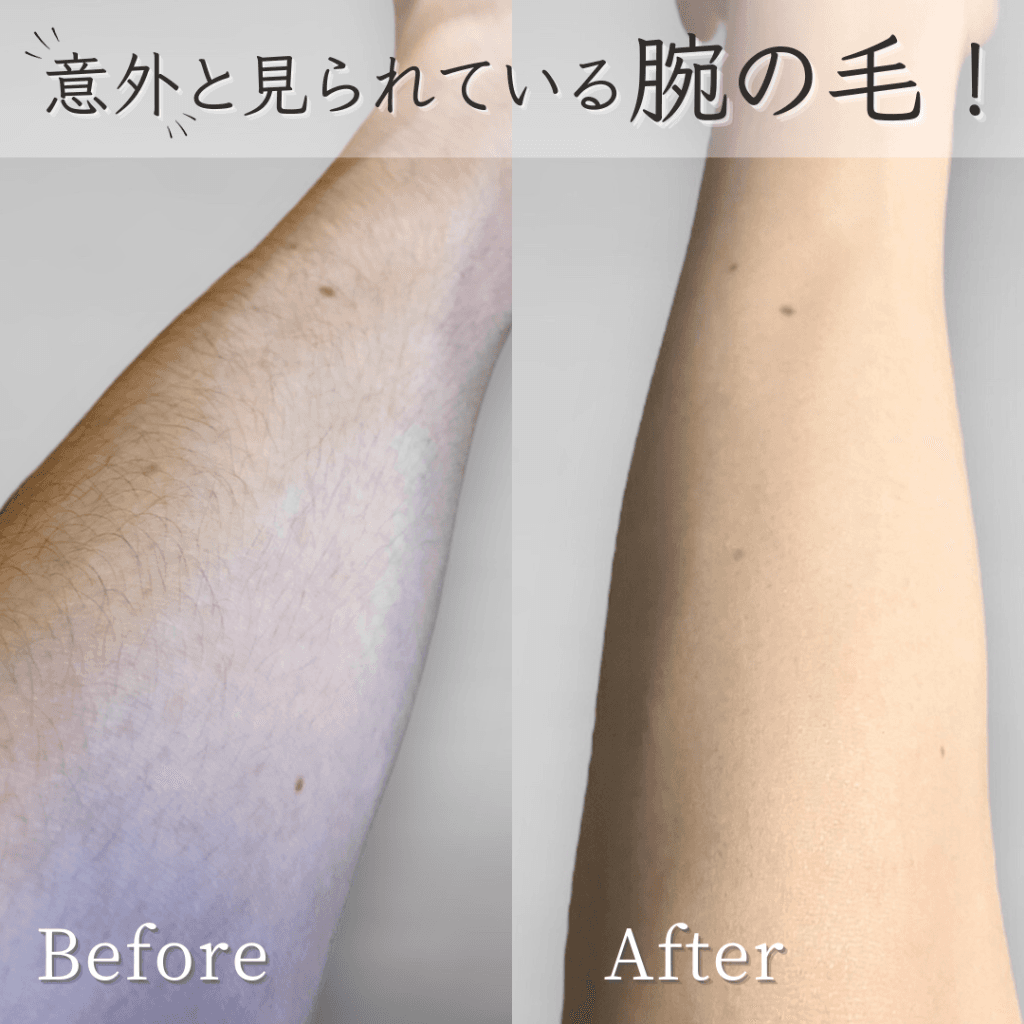 腕の脱毛 施術例（ビフォーアフター）
