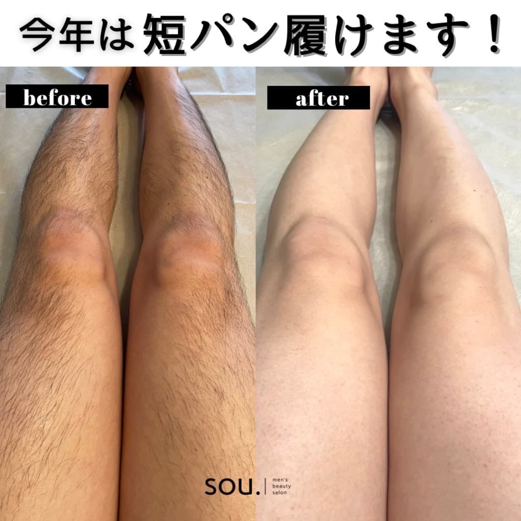 脚の脱毛 施術例（ビフォーアフター）